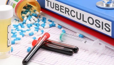 casos activos de tuberculosis