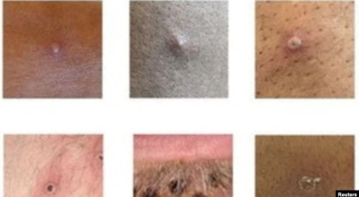 lesiones que provoca la viruela del mono